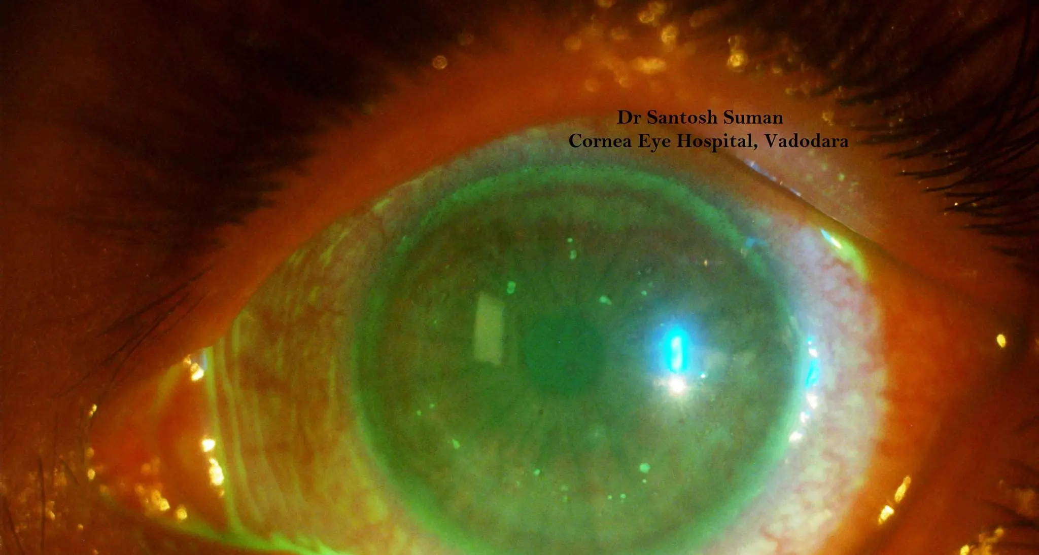 NT eye infection diagnosed in Wangaratta